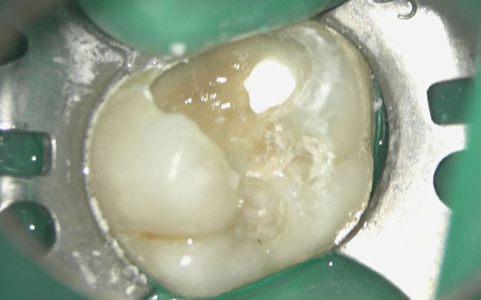 歯髄保存治療の症例